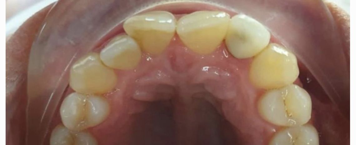 Angel Aligners Angel Aligners Before