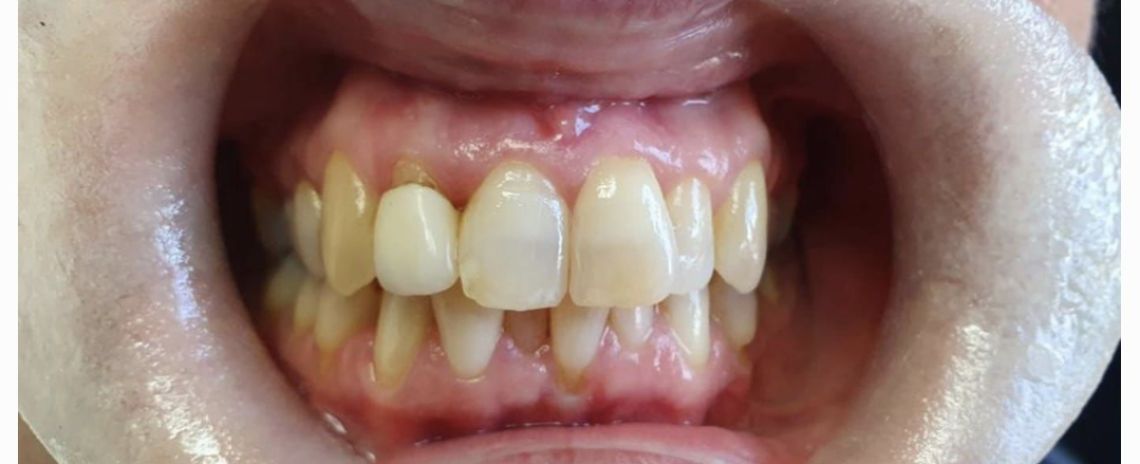 Angel Aligners Angel Aligners Before