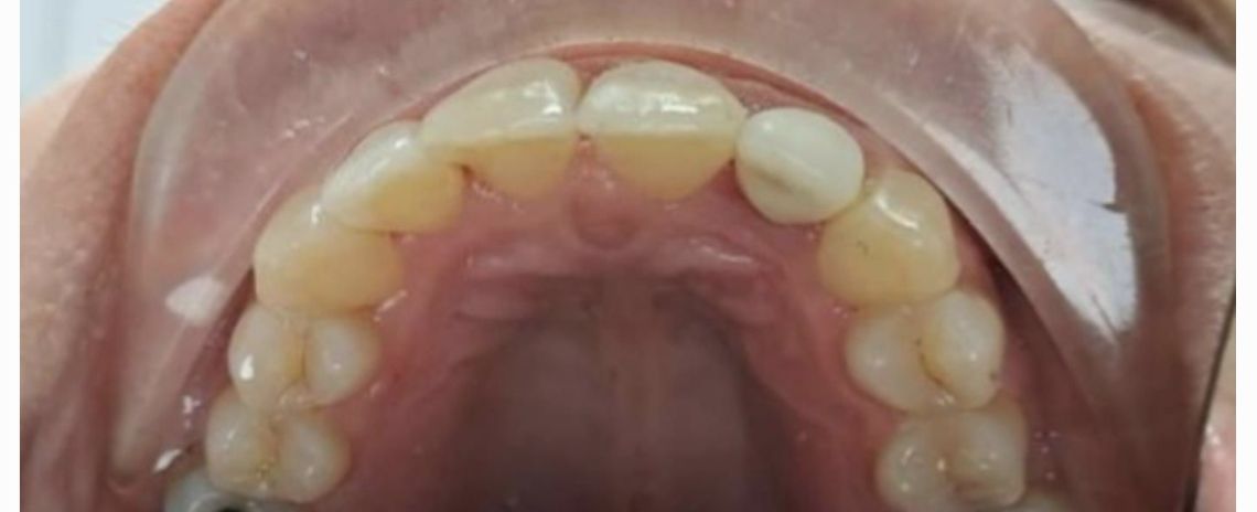 Angel Aligners Angel Aligners After