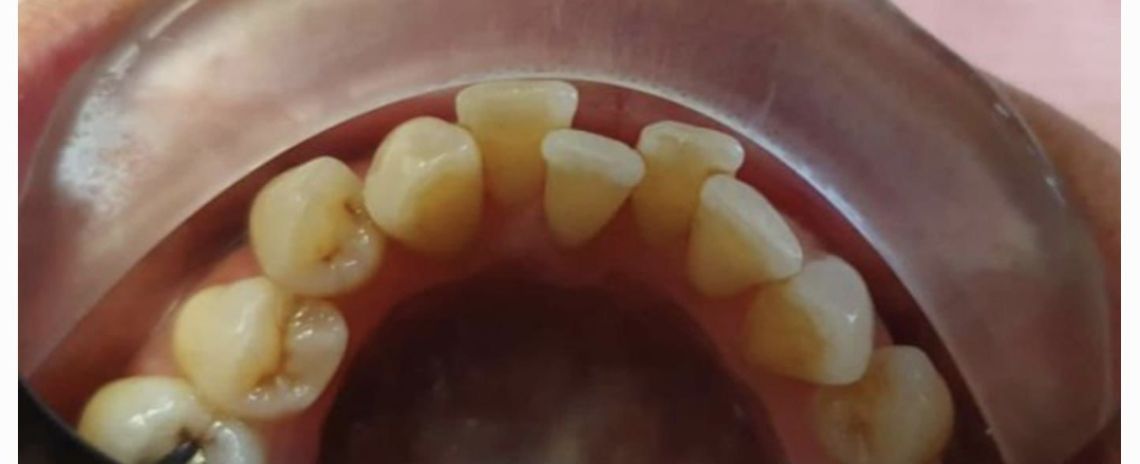 Angel Aligners Angel Aligners Before