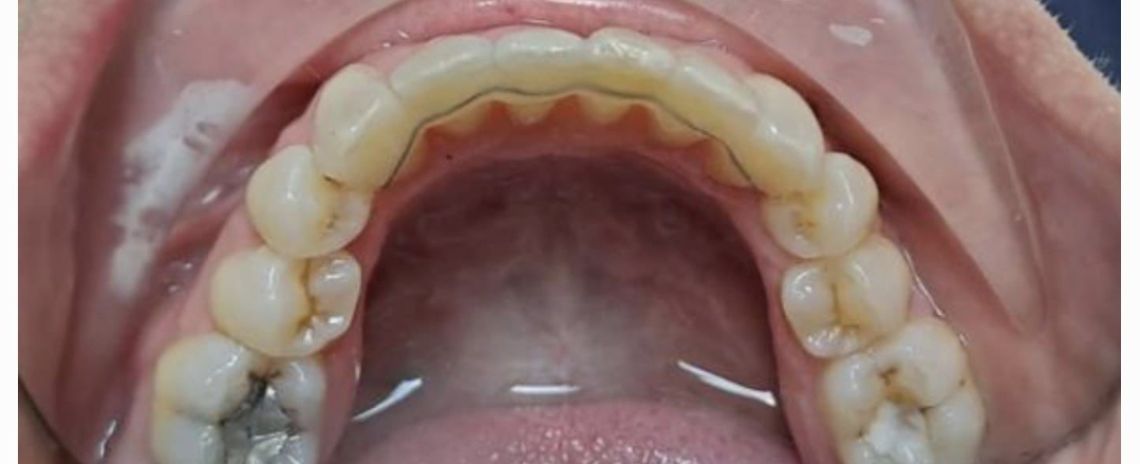 Angel Aligners Angel Aligners After