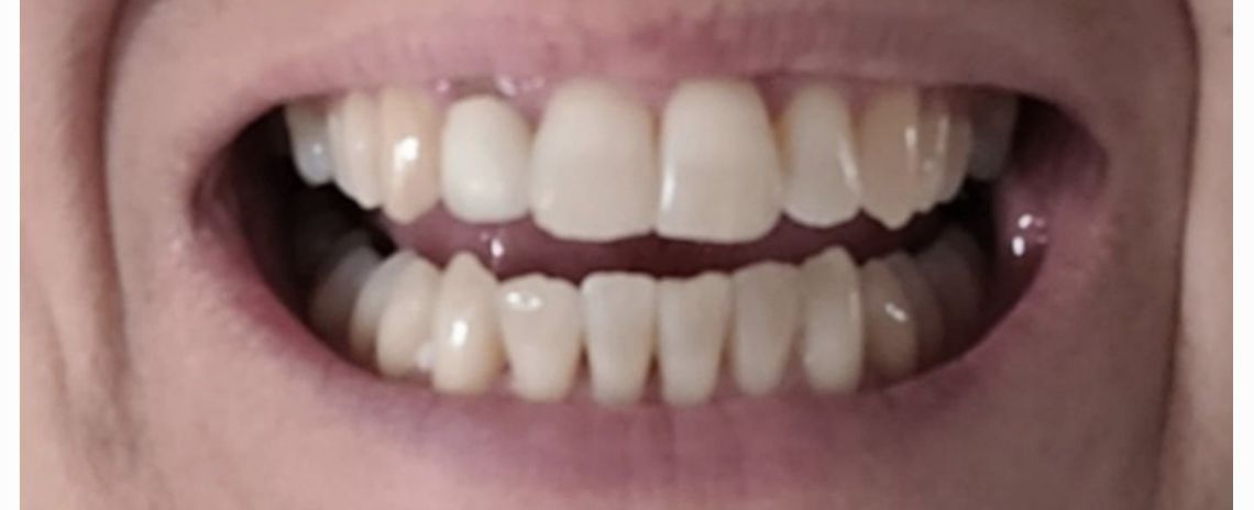 Angel Aligners Angel Aligners After